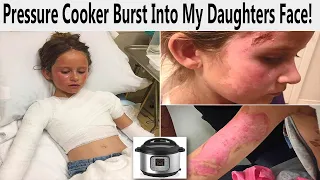 r/WellThatSucks | Pressure Cooker Burst Into My Daughter's Face