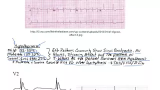 STEMI mimics and Confounders II