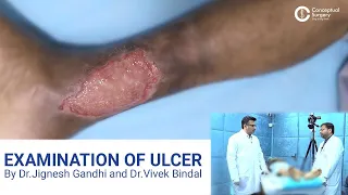 Examination of Ulcer By Dr. Jignesh Gandhi and Dr. Vivek Bindal @conceptual surgery