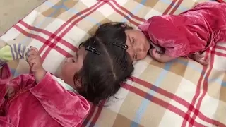 Conjoined Twins Celebrate Their First Birthday