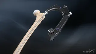 Antegrade Femoral Nail System Surgical Technique