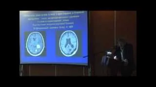 Хирургия метастатических опухолей головного мозга