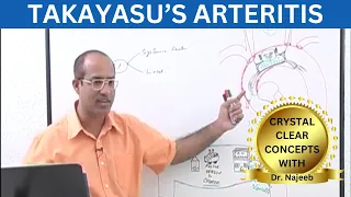 Takayasu's Arteritis | TAK | Complications | Management