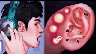 Pimple blackhead and sebaceous cyst removal for gamer | Massage ear - Tingle animation