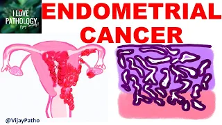 ENDOMETRIAL CARCINOMA: Risk factors, Etiopathogenesis, Morphology & Clinical features