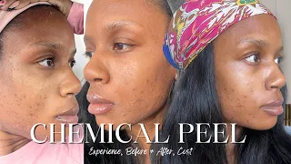 MY CHEMICAL PEEL EXPERIENCE *intense peeling* Before & After | Process | VI Peel Precision Plus