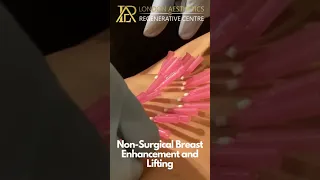 Successful Non-surgical breast enhancement &Lifting procedure done with Dermal Fillers & PDO Threads