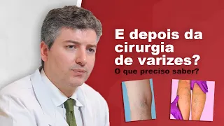 Como é o pós operatório da cirurgia de Varizes convencional/tradicional