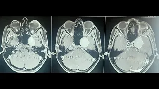 CAVERNOUS SINUS MENINGIOMA