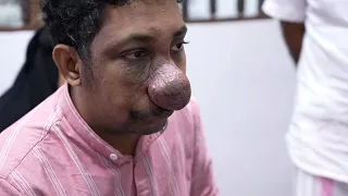 The BIGGEST Nose Tumor Doctor Has Ever Seen!