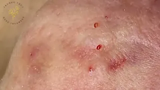 SAC DEP SPA Blackheads | #846