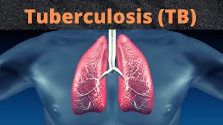 What Happens in Tuberculosis (TB)? | 3D Animation |, Causes, Symptoms, Treatment (Urdu/Hindi)