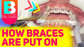 Getting Braces 101 - Putting Braces On