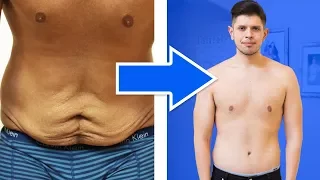 I Got Surgery To Get Rid Of My Loose Skin