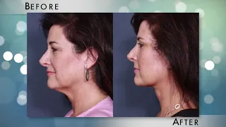 Dr. Brahme | What is a Mini Facelift?