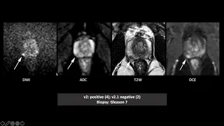 PI-RADS v2 and v2.1: Interobserver Agreement and Diagnostic Performance in PZ and TZ lesions