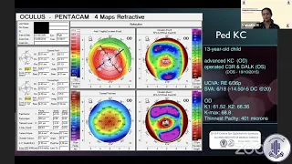 Pediatric Corneal Diseases: Pediatric Keratoconus Indian Perspective By Dr. M. Vanathi