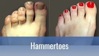 Hammertoes: Why do they hurt and how to fix them!