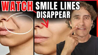 Nasolabial Folds DIY Hacks vs MedSpa Solutions