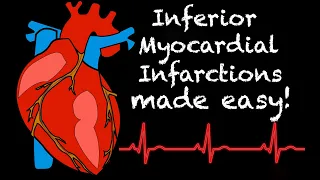 EMS Cardiology || Tachy Tuesday: Inferior Myocardial Infarction (STEMI)