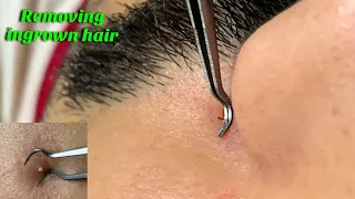 ASMR super ZOOM Removing ingrown hair on face.