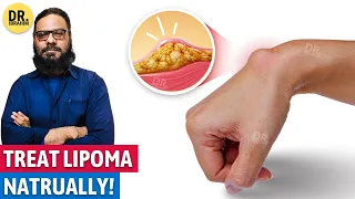 Lipoma Ka Qudrati Ilaj | Natural Remedies for Lipoma | Urdu/Hindi | Dr. Ibrahim