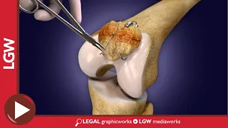 Removal of Buried Hardware In Knee 3D Animation