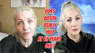 Does Botox really help at 61 years old??? - Dysport injection review for crows feet & 11's - bentlyk