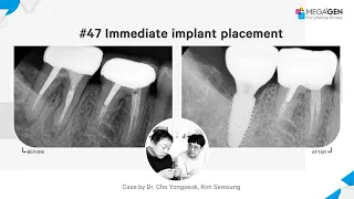 Dr. Yongseok CHO, Sewoung KIM, #47 immediate implant surgery and prosthesis