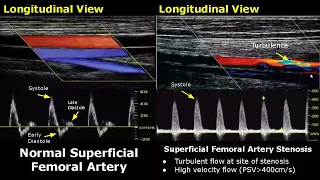 Femoral Artery Doppler Ultrasound Normal Vs Abnormal | Stenosis/Occlusion/Pseudoaneurysm/AVF USG