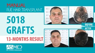 Manual FUE Hair Transplant 5018 Grafts 13 Months Result @asmedhairtransplant ​