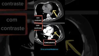TOMOGRAFIA | Com contraste e sem contraste