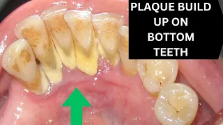 Why Is It Impossible To Keep Bottom Front Teeth Clean?