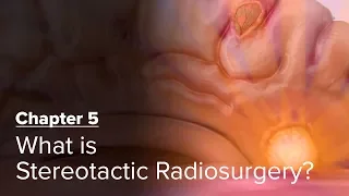 What is Stereotactic Radiosurgery? Chapter 5 — Brain Metastases: A Documentary