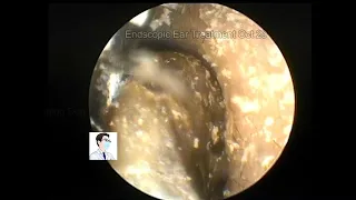 Hard like rock ear wax removing ,11mins,20221029