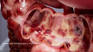 Ulcerative Colitis Medications | 3D Medical Animation | Pixeldust Studios