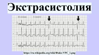 Экстрасистолия