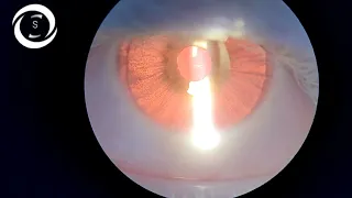 Ophthalmic Signs (Syndromes)