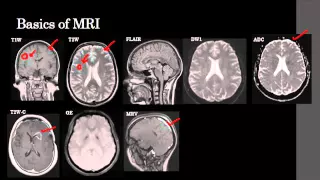 Imaging of skull base - Dr Prahlad