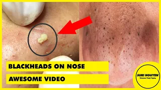 Suri 49: AWESOME BLACKHEADS ON NOSE