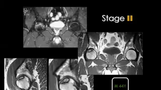 Imaging of Hip joint Aug 2014   Dr Mamdouh Mahfouz In Arabic