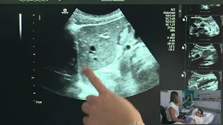 Ultrasound of the Left Liver Lobe