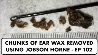 CHUNKS OF EAR WAX REMOVED USING JOBSON HORNE - EP 102