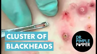 50 Minutes of Blackheads! Clusters of Blackheads with Dr. Pimple Popper