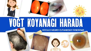 Vogt Koyanagi Harada syndrome | VKH | granulomatous uveitis | ophthalmology