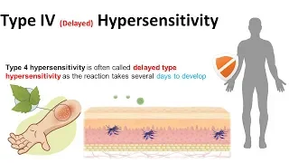 Type IV delayed hypersensitivity