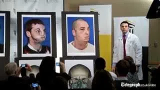 US gun injury victim receives 'most extensive full face transplant ever'