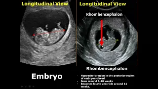 First Trimester & Ectopic Pregnancy Ultrasound Image Appearances