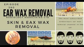 SKIN & EAR WAX REMOVAL   EP380