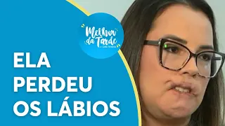 Tragédia estética: mulher perde lábios após procedimento |Melhor da Tarde